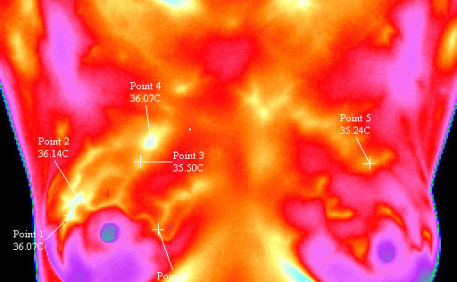 Slika prikazuje infrardečo sliko ženskega oprsja. Svetel del na desni dojki označuje rakave tvorbe.